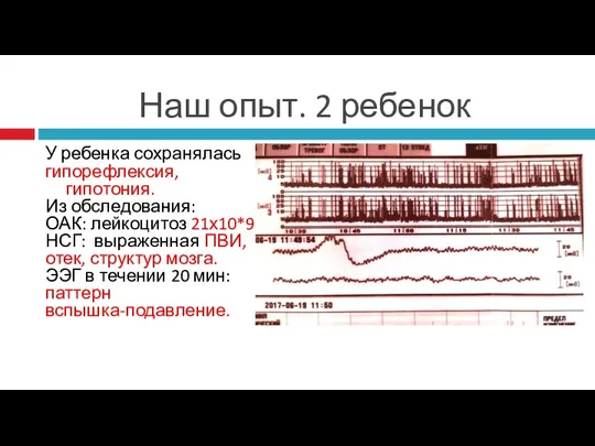 Наш опыт. 2 ребенок У ребенка сохранялась гипорефлексия, гипотония. Из