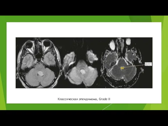 Классическая эпендимома, Grade II