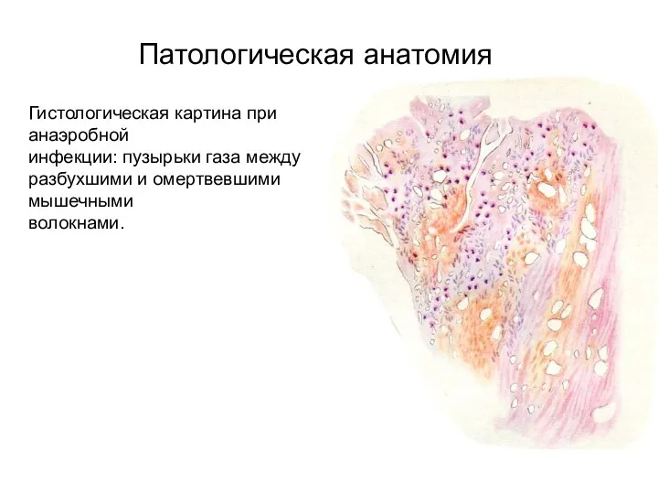 Гистологическая картина при анаэробной инфекции: пузырьки газа между разбухшими и омертвевшими мышечными волокнами. Патологическая анатомия