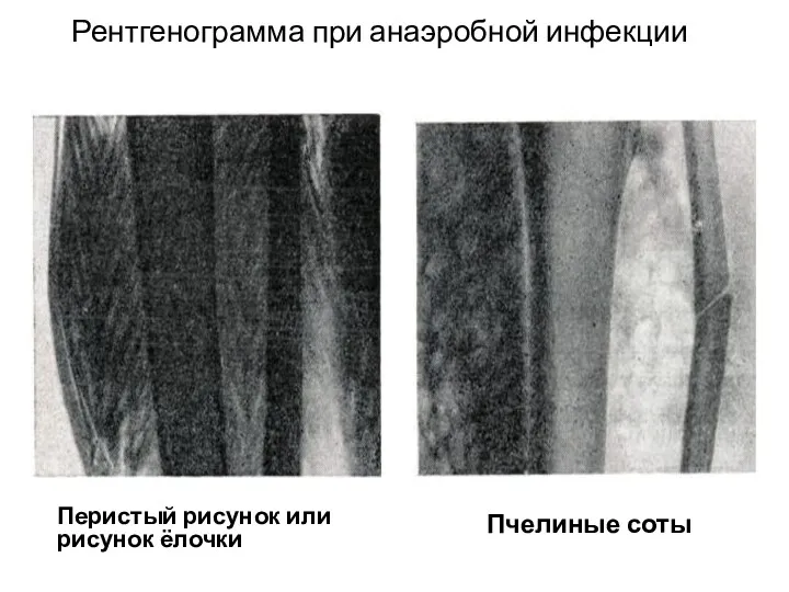 Рентгенограмма при анаэробной инфекции Перистый рисунок или рисунок ёлочки Пчелиные соты