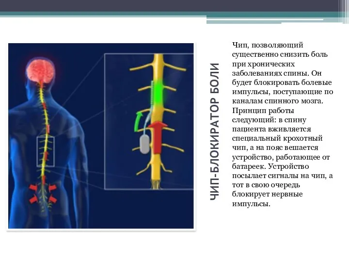 ЧИП-БЛОКИРАТОР БОЛИ Чип, позволяющий существенно снизить боль при хронических заболеваниях