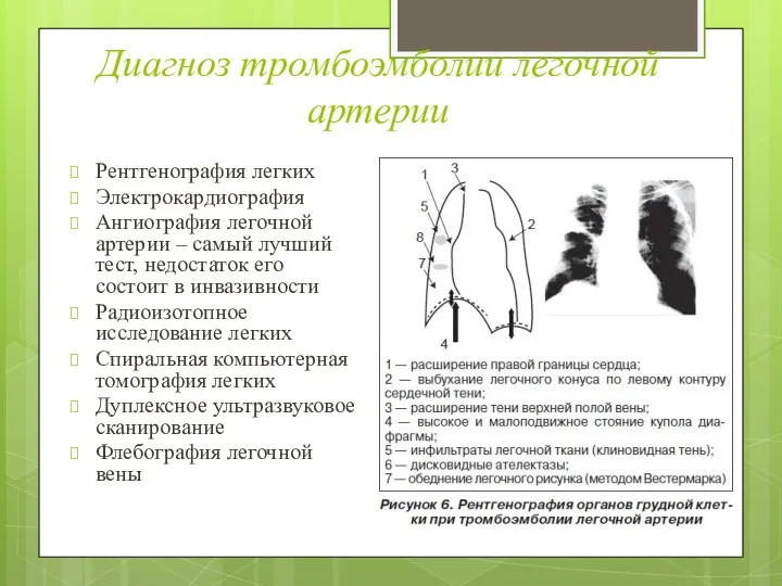 Диагноз тромбоэмболии легочной артерии Рентгенография легких Электрокардиография Ангиография легочной артерии