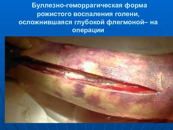 Буллезно-геморрагическая форма рожистого воспаления голени, осложнившаяся глубокой флегмоной– на операции