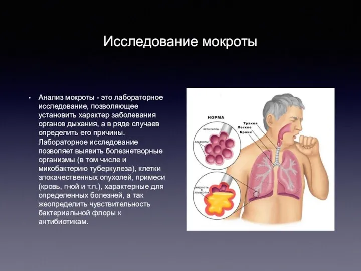 Исследование мокроты Анализ мокроты - это лабораторное исследование, позволяющее установить