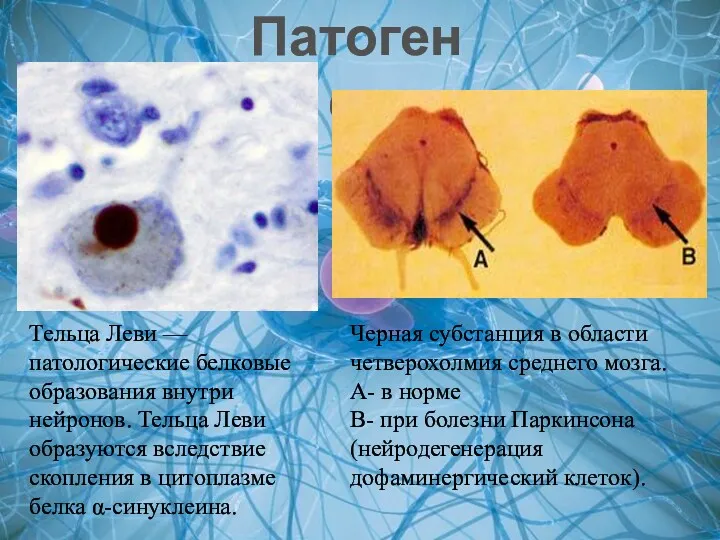 Патогенез Тельца Леви — патологические белковые образования внутри нейронов. Тельца