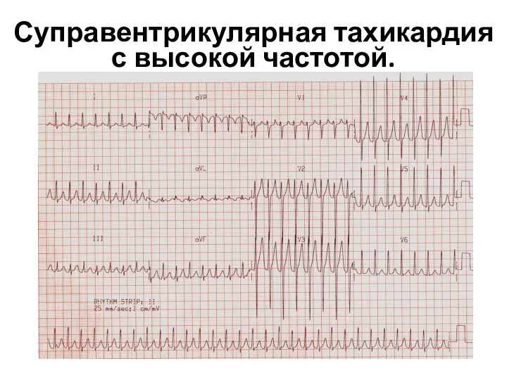 Суправентрикулярная тахикардия с высокой частотой.