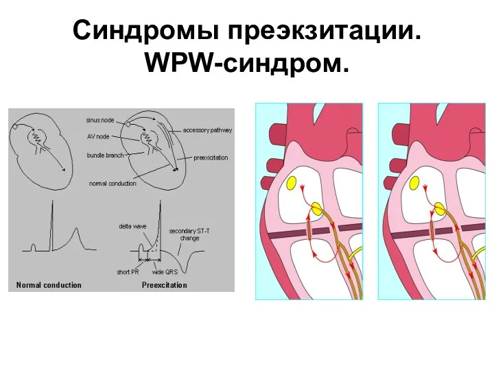 Синдромы преэкзитации. WPW-синдром.
