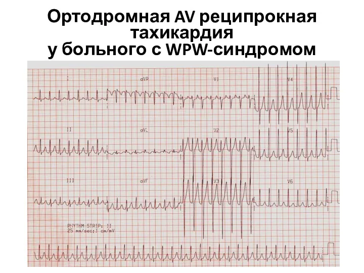 Ортодромная AV реципрокная тахикардия у больного с WPW-синдромом