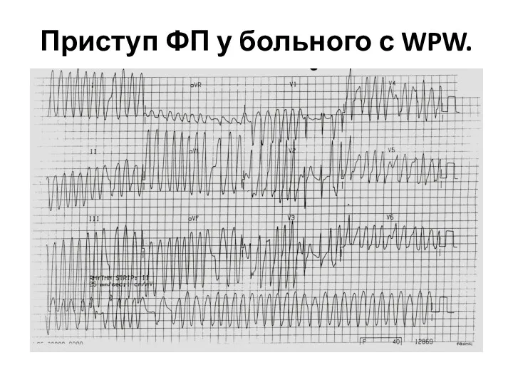 Приступ ФП у больного с WPW.