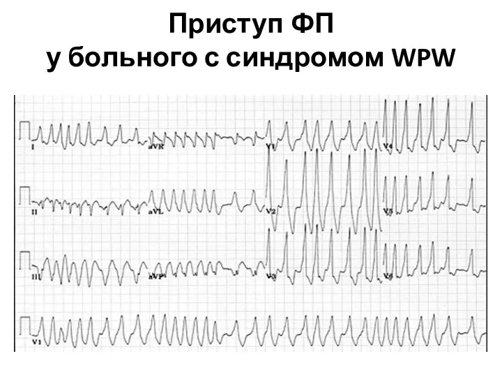 Приступ ФП у больного с синдромом WPW