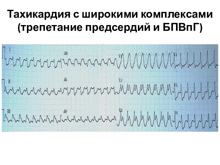 Тахикардия с широкими комплексами (трепетание предсердий и БПВпГ)