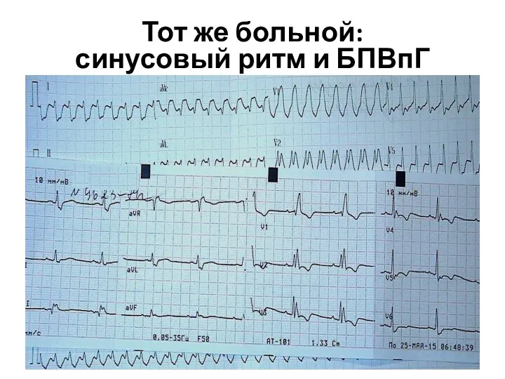 Тот же больной: синусовый ритм и БПВпГ