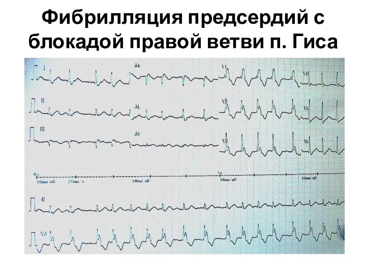 Фибрилляция предсердий с блокадой правой ветви п. Гиса