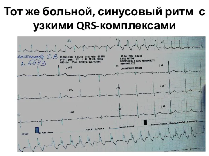 Тот же больной, синусовый ритм с узкими QRS-комплексами