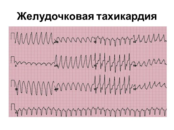 Желудочковая тахикардия