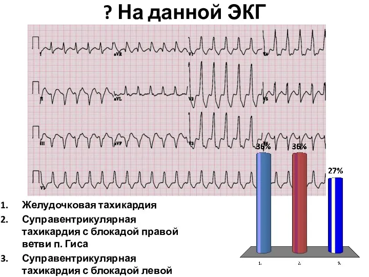 ? На данной ЭКГ Желудочковая тахикардия Суправентрикулярная тахикардия с блокадой правой ветви п.