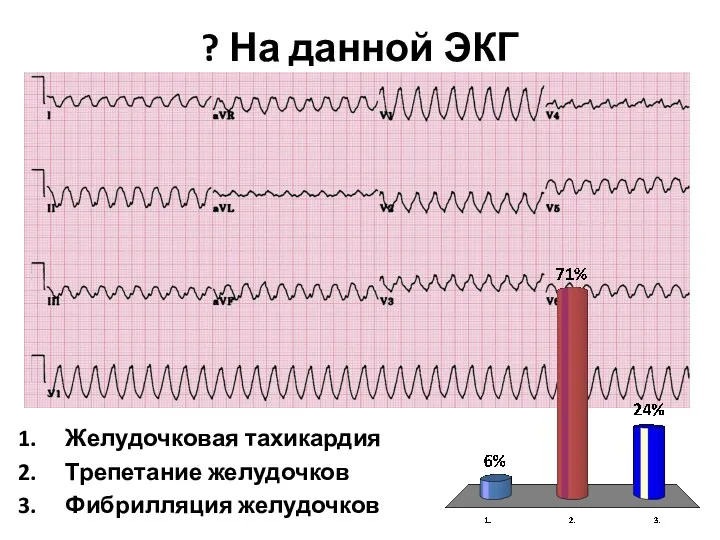 ? На данной ЭКГ Желудочковая тахикардия Трепетание желудочков Фибрилляция желудочков