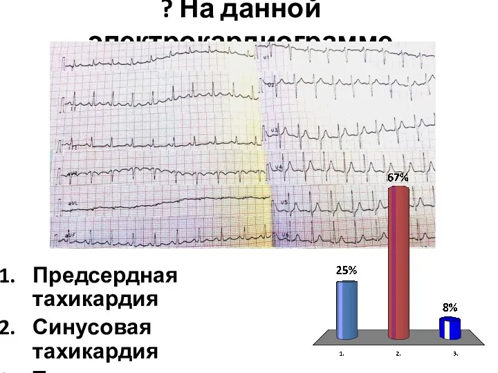 ? На данной электрокардиограмме Предсердная тахикардия Синусовая тахикардия Трепетание предсердий