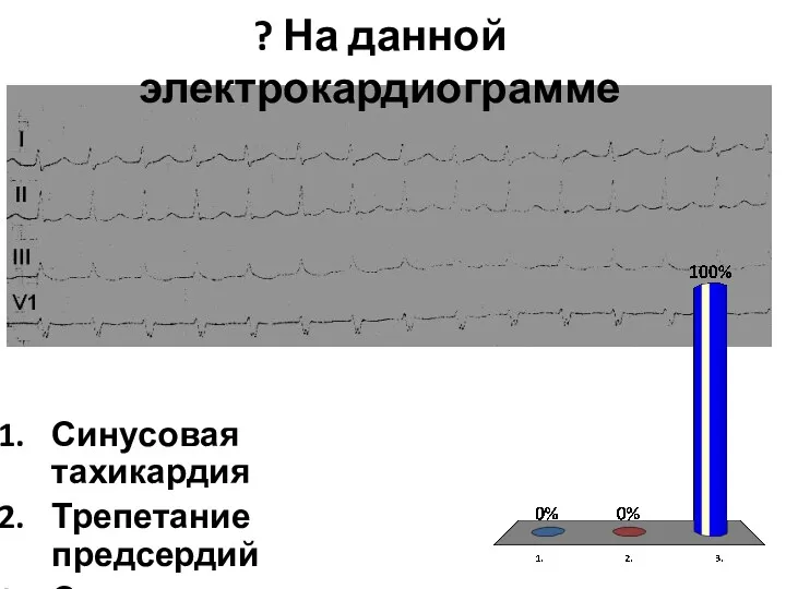 ? На данной электрокардиограмме Синусовая тахикардия Трепетание предсердий Суправентрикулярная тахикардия