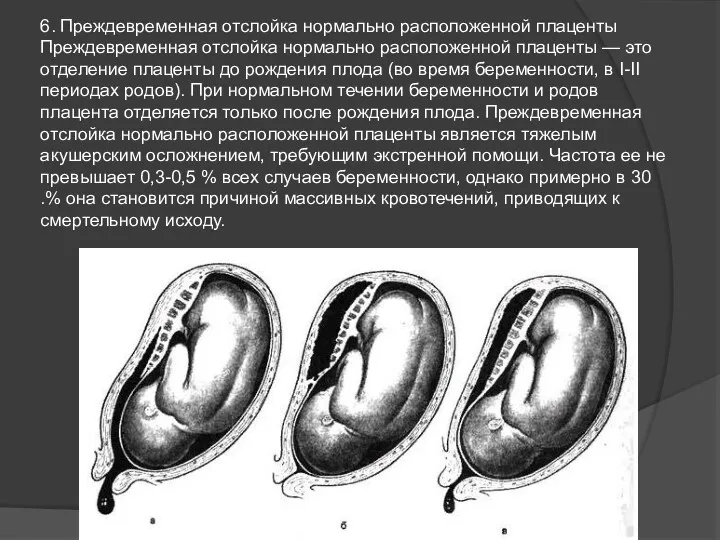 6. Преждевременная отслойка нормально расположенной плаценты Преждевременная отслойка нормально расположенной