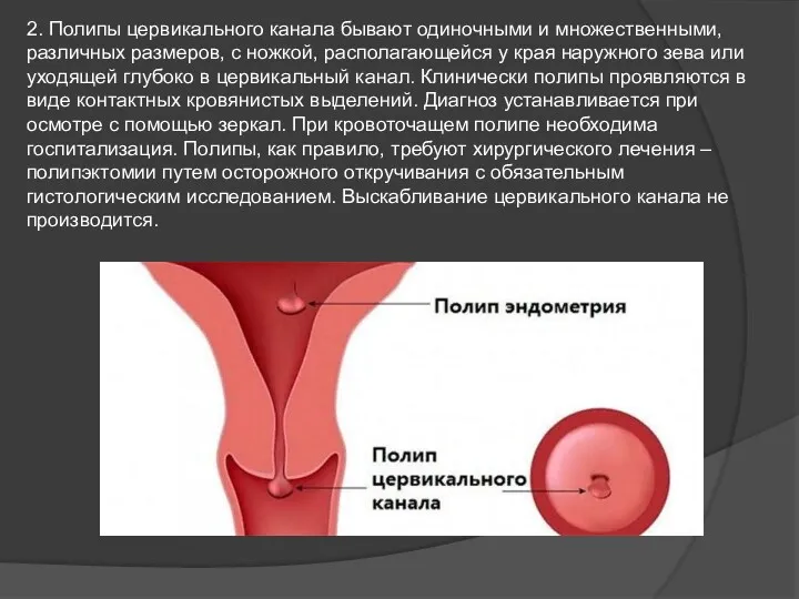 2. Полипы цервикального канала бывают одиночными и множественными, различных размеров,