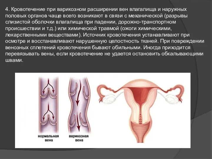 4. Кровотечение при варикозном расширении вен влагалища и наружных половых