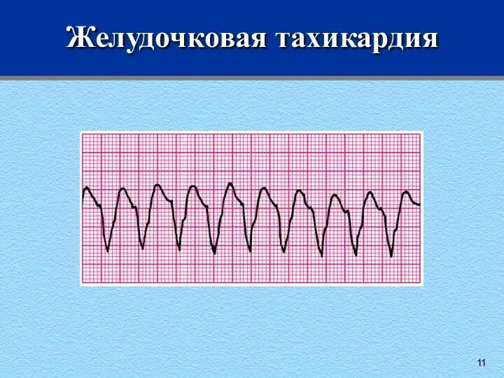 Желудочковая тахикардия