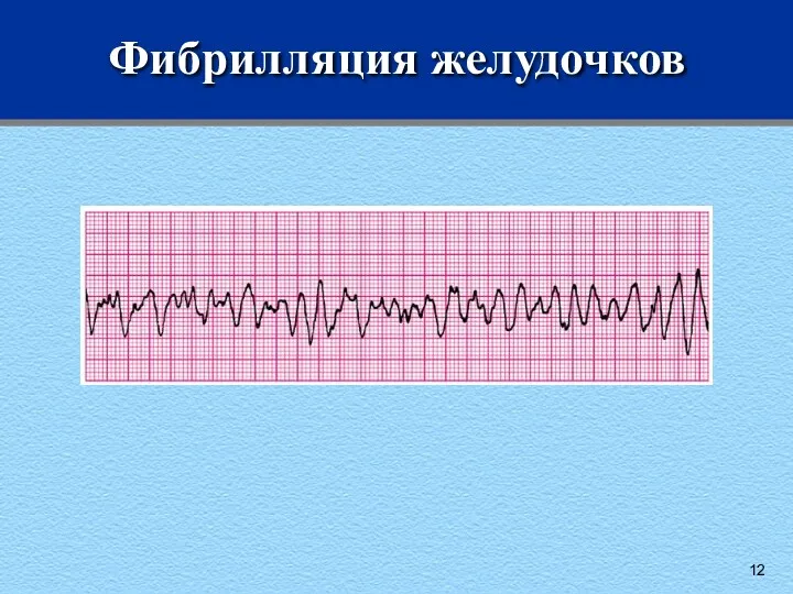 Фибрилляция желудочков