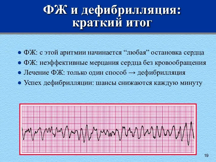 ФЖ и дефибрилляция: краткий итог ФЖ: с этой аритмии начинается