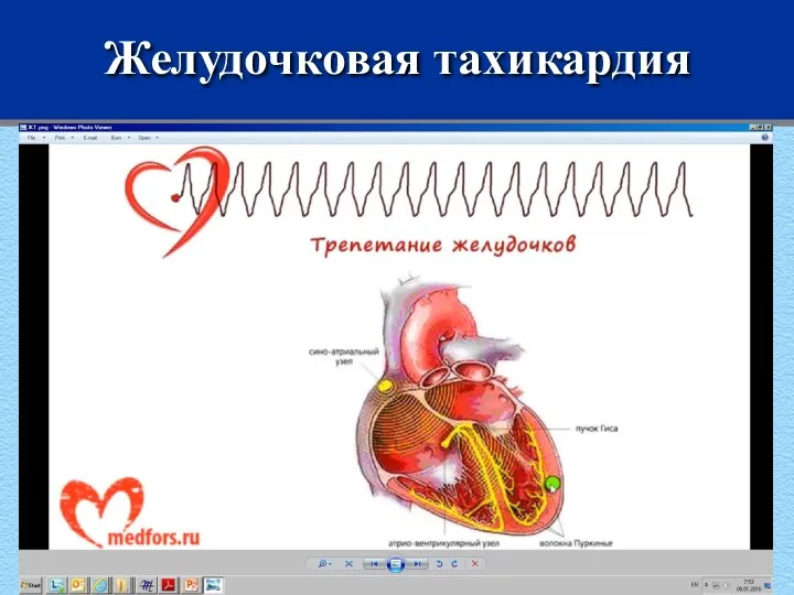 Желудочковая тахикардия