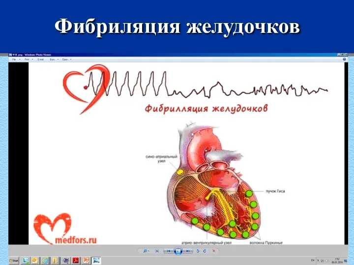 Фибриляция желудочков