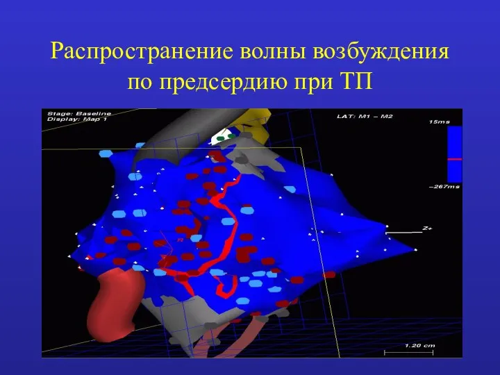 Распространение волны возбуждения по предсердию при ТП