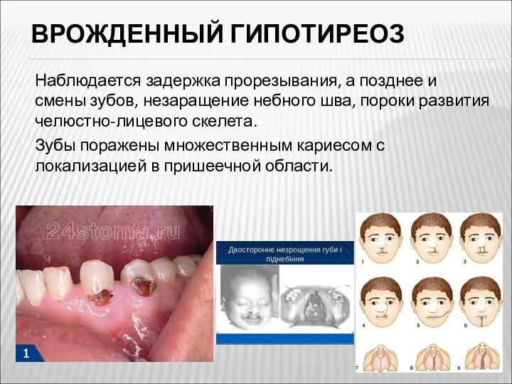 Наблюдается задержка прорезывания, а позднее и смены зубов, незаращение небного шва, пороки развития