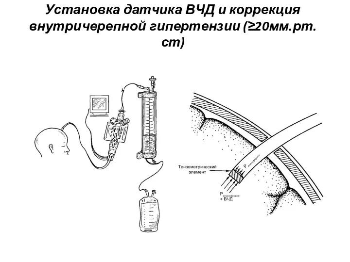 Установка датчика ВЧД и коррекция внутричерепной гипертензии (≥20мм.рт.ст)