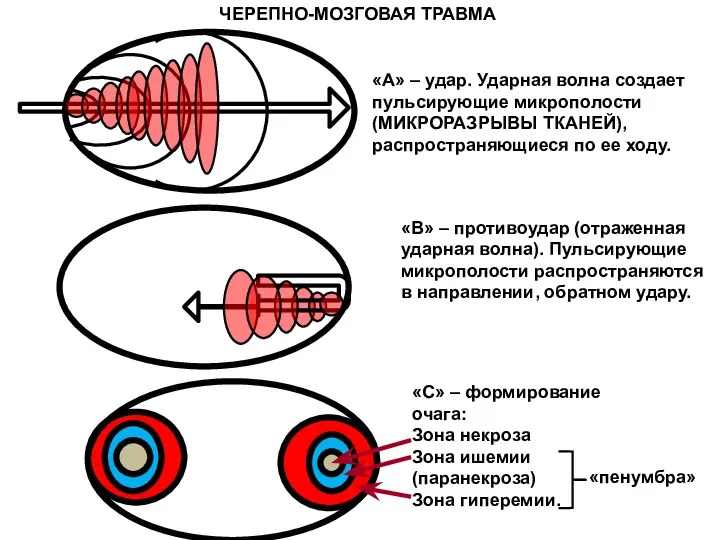 «А» – удар. Ударная волна создает пульсирующие микрополости (МИКРОРАЗРЫВЫ ТКАНЕЙ),