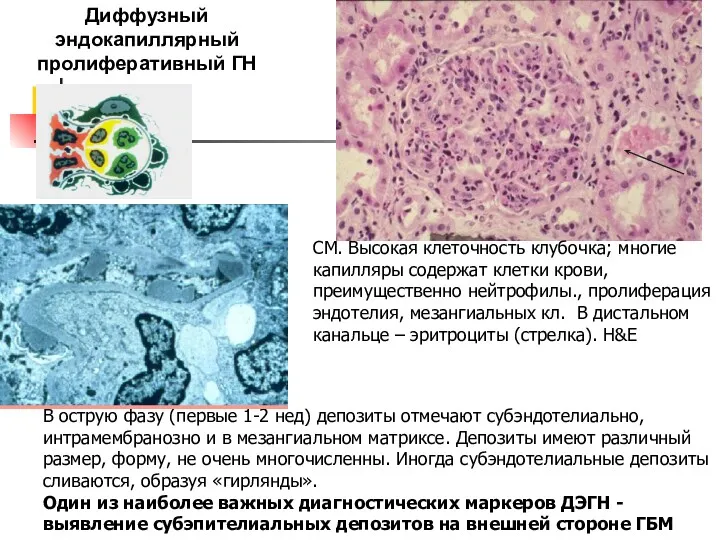 Диффузный эндокапиллярный пролиферативный ГН СМ. Высокая клеточность клубочка; многие капилляры