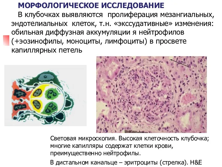 Световая микроскопия. Высокая клеточность клубочка; многие капилляры содержат клетки крови,