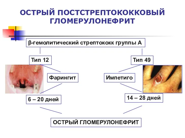 ОСТРЫЙ ПОСТСТРЕПТОКОККОВЫЙ ГЛОМЕРУЛОНЕФРИТ β-гемолитический стрептококк группы А Тип 12 Тип