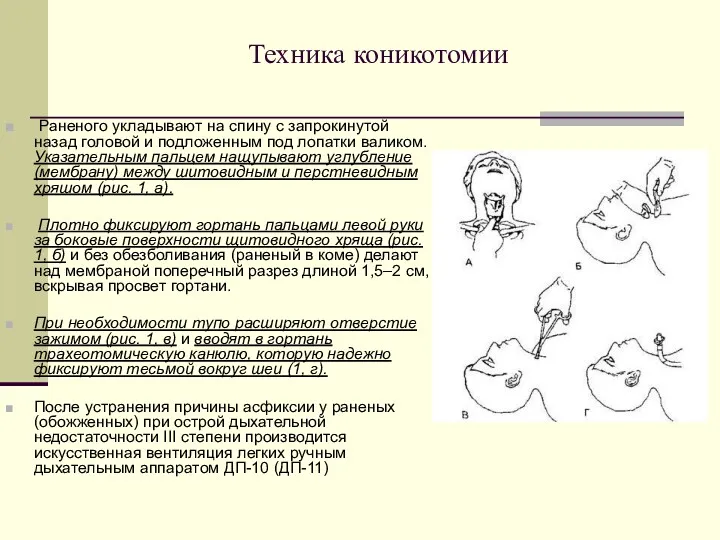 Техника коникотомии Раненого укладывают на спину с запрокинутой назад головой