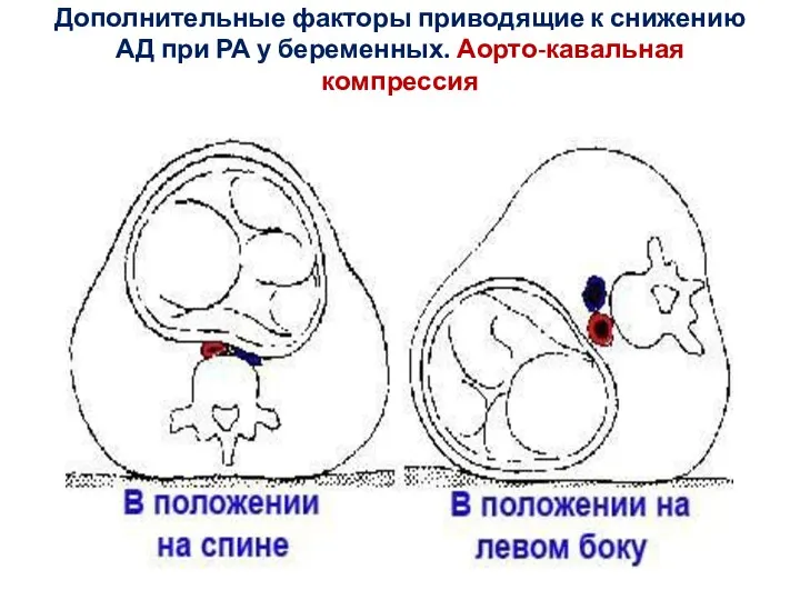 Дополнительные факторы приводящие к снижению АД при РА у беременных. Аорто-кавальная компрессия