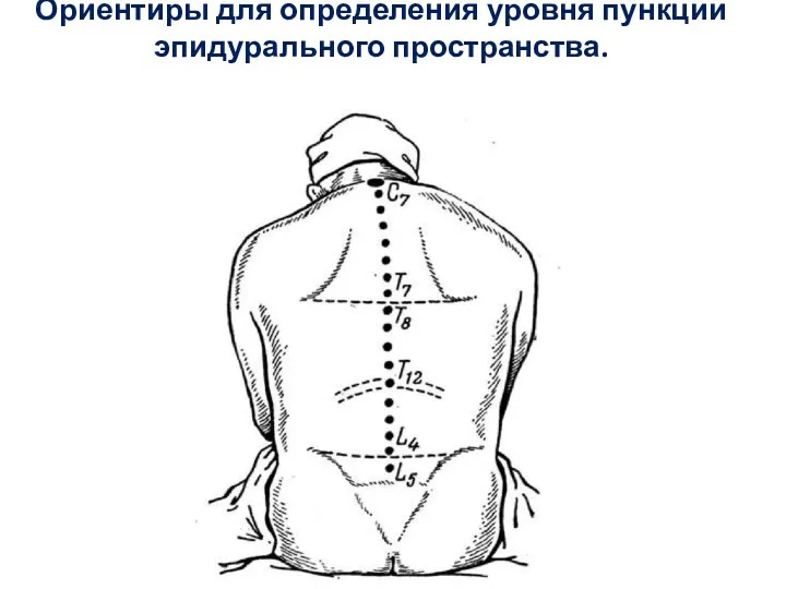 Ориентиры для определения уровня пункции эпидурального пространства.