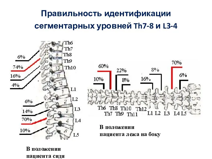 Правильность идентификации сегментарных уровней Th7-8 и L3-4 В положении пациента