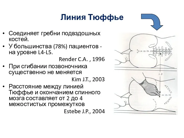 Линия Тюффье Соединяет гребни подвздошных костей. У большинства (78%) пациентов