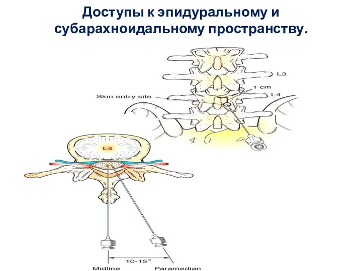 Доступы к эпидуральному и субарахноидальному пространству.