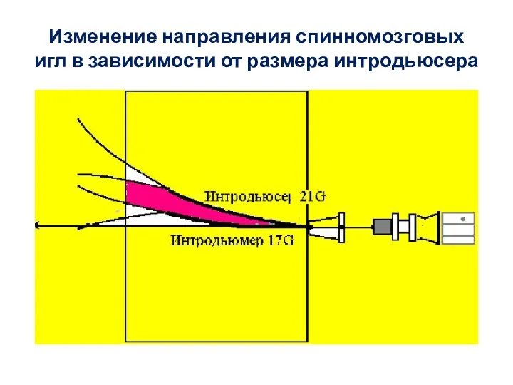 Изменение направления спинномозговых игл в зависимости от размера интродьюсера