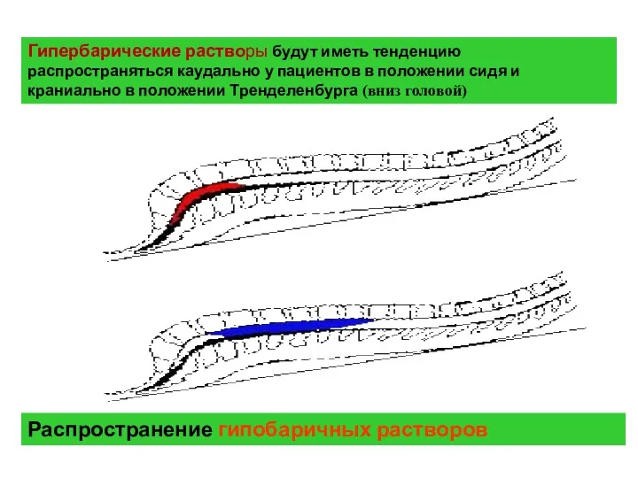 Гипербарические растворы будут иметь тенденцию распространяться каудально у пациентов в