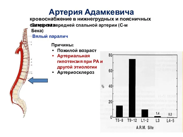 Артерия Адамкевича Синдром передней спальной артерии (С-м Бека) Вялый паралич