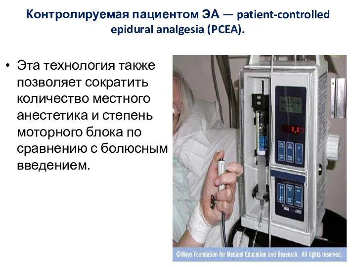 Контролируемая пациентом ЭА — patient-controlled epidural analgesia (PCEA). Эта технология