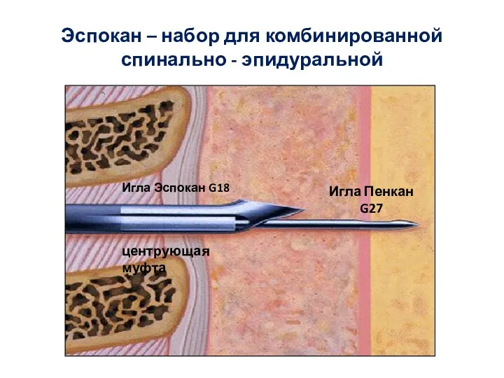 Эспокан – набор для комбинированной спинально - эпидуральной Игла Эспокан G18 Игла Пенкан G27 центрующая муфта