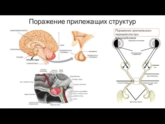 Поражение прилежащих структур Поражение зрительного перекрёста при макроадномах